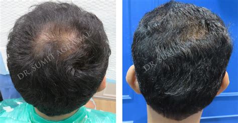 Real Results - Vertex Hair Transplant