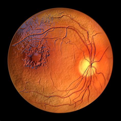 Macular Edema