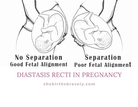 7 Diastasis Recti Symptoms Every Mom Should Know | She Births Bravely
