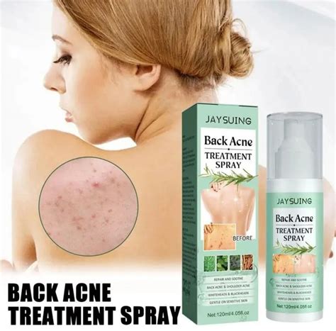 Back Acne Treatment