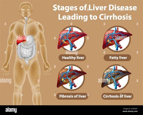 Stages of liver disease leading to Cirrhosis illustration Stock Vector Image & Art - Alamy