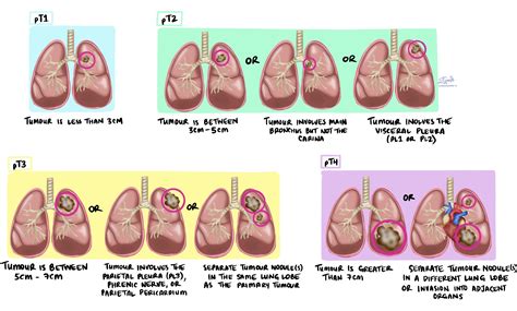 Your pathology report for adenosquamous carcinoma of the lung ...