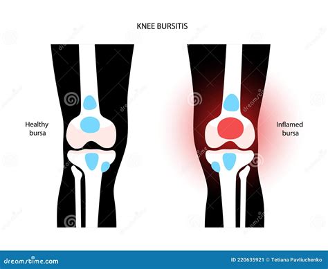 Knee Bursitis_Superficial Infrapatellar Bursitis Cartoon Vector ...