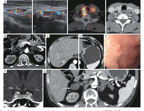 Figure 1 from A narrative review of multiple endocrine neoplasia syndromes: genetics, clinical ...
