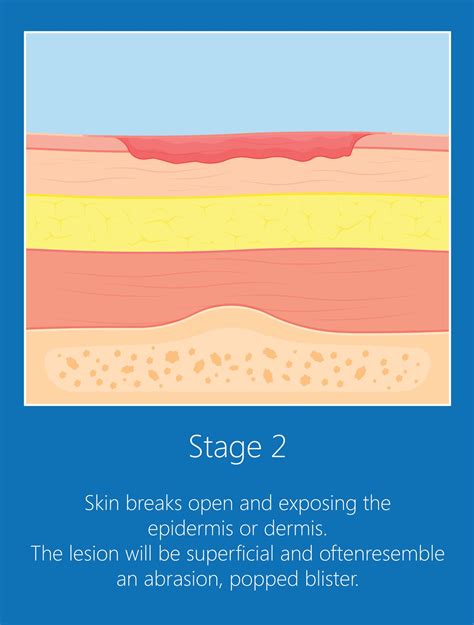 What Is Pressure Ulcer Stage 2 at Inez Woodford blog