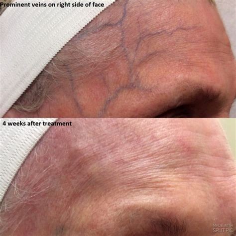 Spider Veins On Face