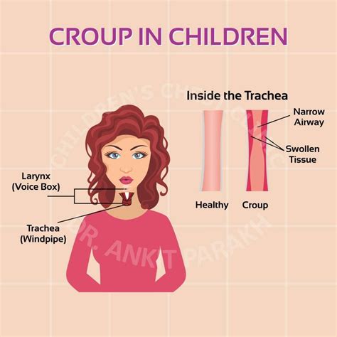 Croup in Children – Symptoms, Diagnosis and Treatment – Dr. Ankit ...