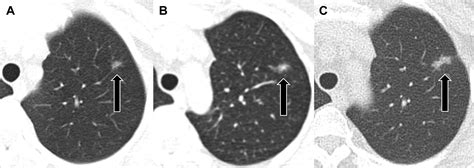 What Is Ground Glass Opacity Lung Nodules - Glass Designs