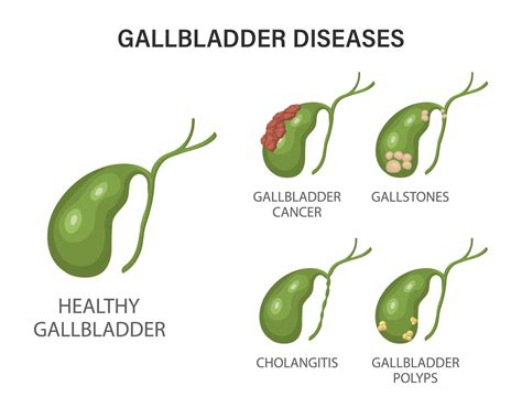 Gallbladder diseases infographics. Gallstone disease, cancer, acute cholecystitis, cholangitis ...