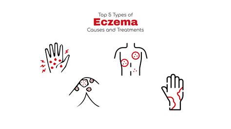 Eczema Causes List at Maria Joiner blog