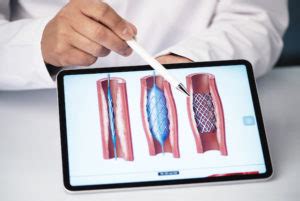 Ballondilatation (PTCA) Stentimplantation | Kardiologie, Prof. Chatterjee