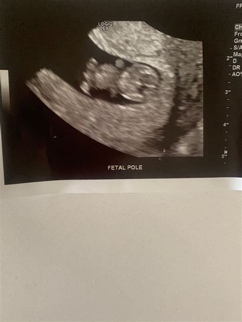 9 Week Fetus Ultrasound