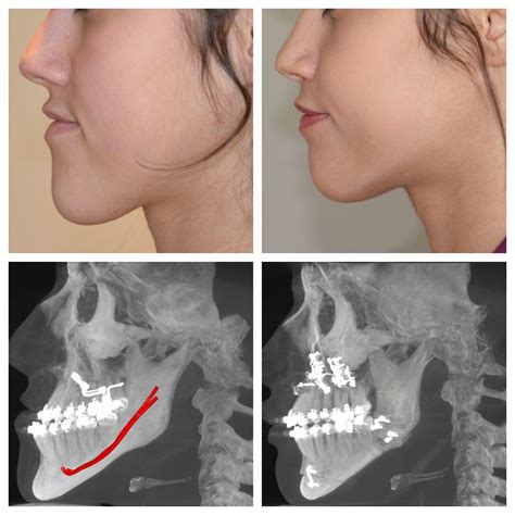 Corrective and orthognathic jaw surgery dr richard w joseph – Artofit