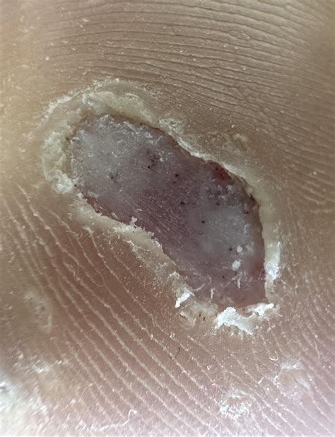 Are the black dots wart vessels? Or is it gone? : r/Warts