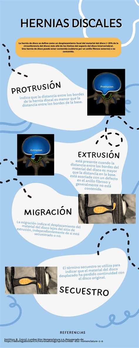 Hernias discales infografía - La hernia de disco se define como un desplazamiento focal del ...