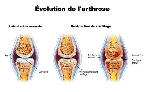 L'arthrose : Causes, Symptômes, Prévention et Traitement de l'arthrose