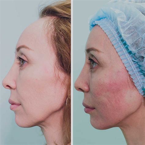 Image result for Thread Lift Problems