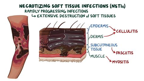 Necrotizing soft tissue infections: Clinical sciences - Osmosis Video ...