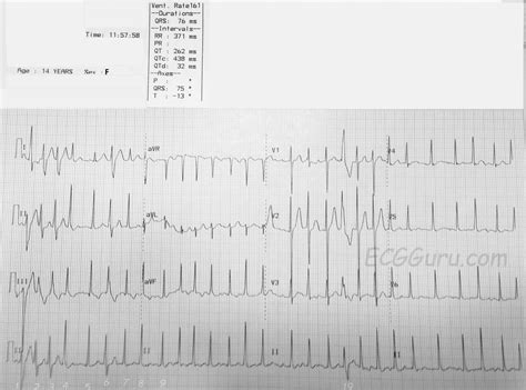 Atrial Fibrillation With Aberrant Conduction in Adolescent Patient ...