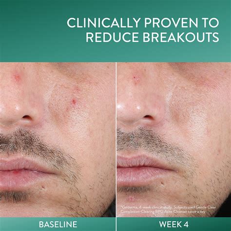 Does Exfoliating Help Blind Pimples at Harry Boykin blog