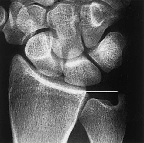 Ulnar Variance - Hand - Orthobullets