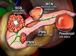 Image result for Neoplasm