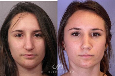 Turbinate Surgery Recovery