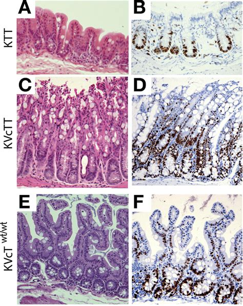 TGF-β Receptor Inactivation and Mutant Kras Induce Intestinal Neoplasms in Mice via a β-Catenin ...