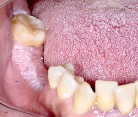 Linea Alba Cheek Biting