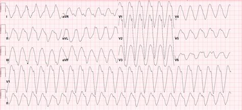 A very wide complex tachycardia - Heart Rhythm
