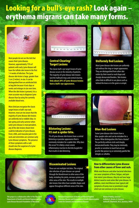 Lyme Disease Bullseye Skin Rash Tick Bite | Lyme Warrior | Lyme Warrior.