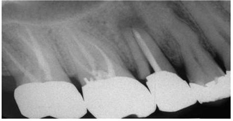 提高牙髓治疗后成功牙齿修复的关键原则|临床注意|陕西嘉友科贸有限公司