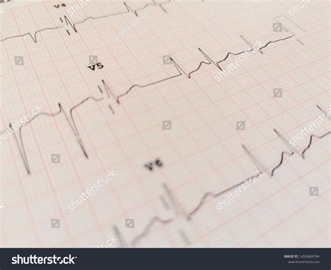 15 Atrial Fibrillation Rhythm Strip Images, Stock Photos & Vectors ...