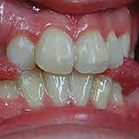 What Is A Tongue Thrust at Marcus Riedel blog