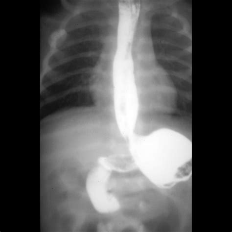 Newborn with bilious vomiting | Pediatric Radiology Case | Pediatric ...