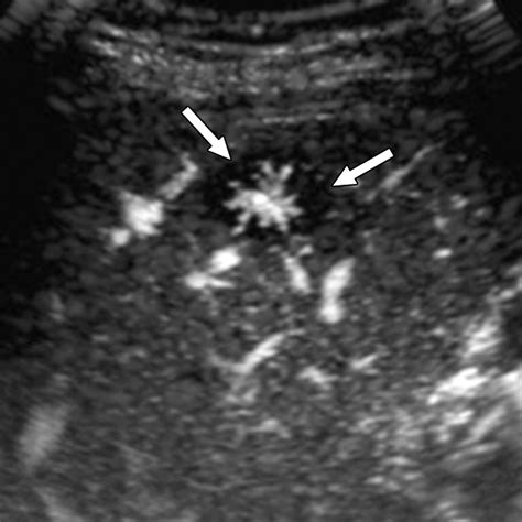 Focal Nodular Hyperplasia and Hepatic Adenoma: Differentiation with Low ...