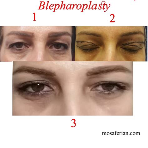 blepharoplasty recovery - Niayesh Beauty Clinic
