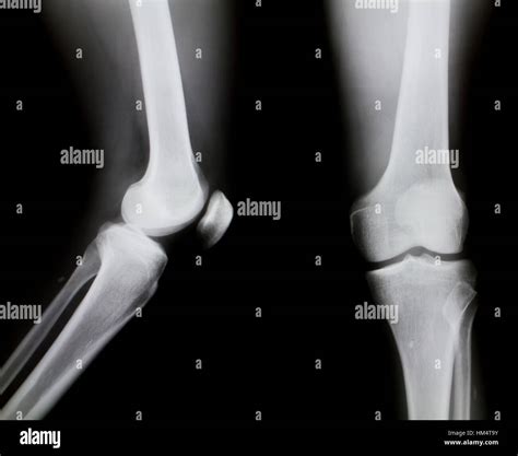 List 102+ Pictures What Does A Normal Knee Xray Look Like Stunning