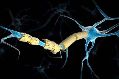 Removing zombie-like cells may help treat multiple sclerosis - ScienceX ...