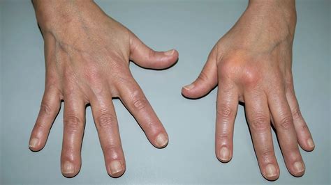 How Autoimmune Disease Can Affect Skin and Hair