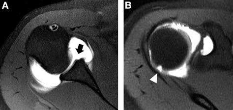 Microfracture in Linear, Isolated, Narrow, Engaging Hill-Sachs Lesion ...