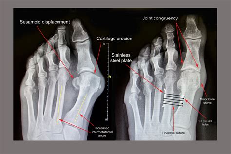 Bunion X Ray
