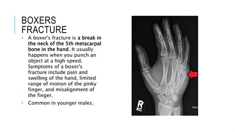 metacarpals & phalanges fractures.pptx