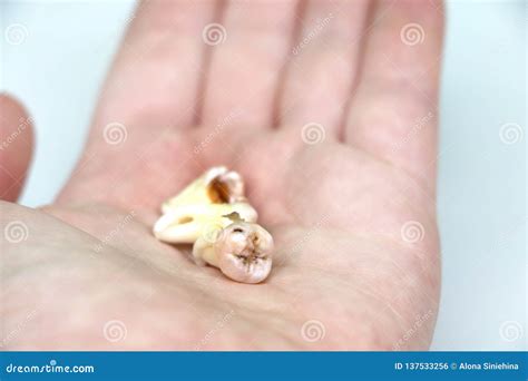 Removed Wisdom Tooth on White Stock Photo - Image of close, decay: 137533256