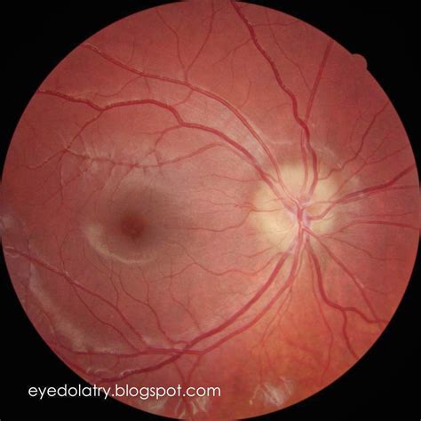The Patient's Guide to Optic Nerve Drusen - Eyedolatry