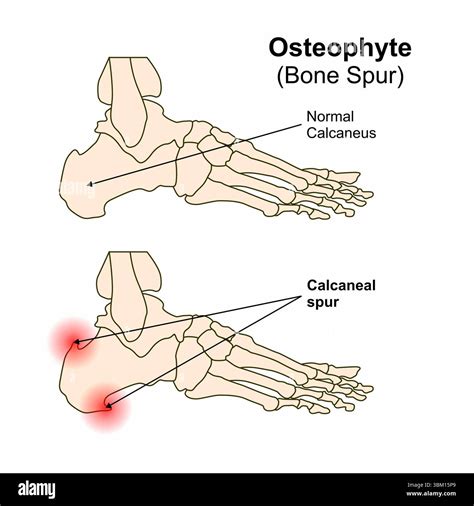 Bone Spur (Osteophyte Stock Photo - Alamy