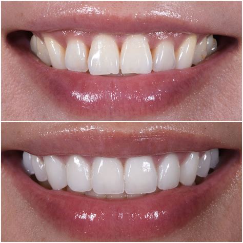 Bulky Veneers