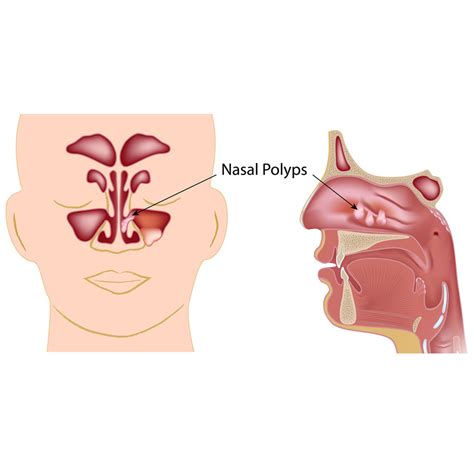 Nasal polyps - Vejthani International Hospital | JCI Accredited ...