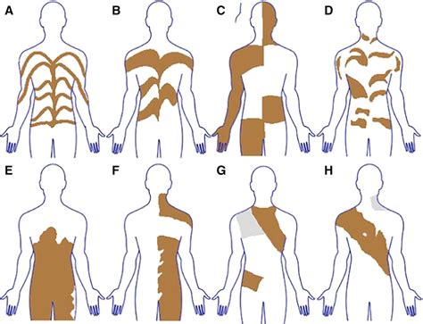 Human Chimerism