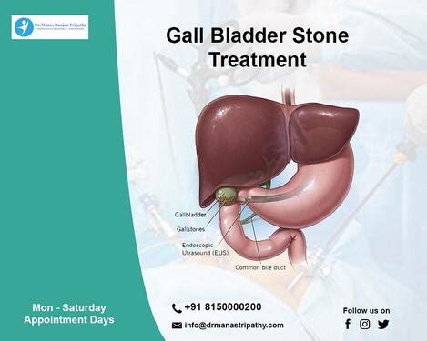 Gall Bladder Stone Treatment In Bangalore Koramangla - Bangalore - Click.in